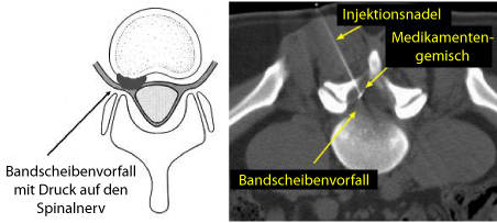 CT-gestützte Injektion gegen Rückenschmerzen