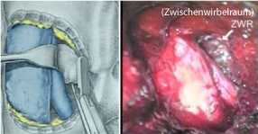 Mikrochirurgische Operation